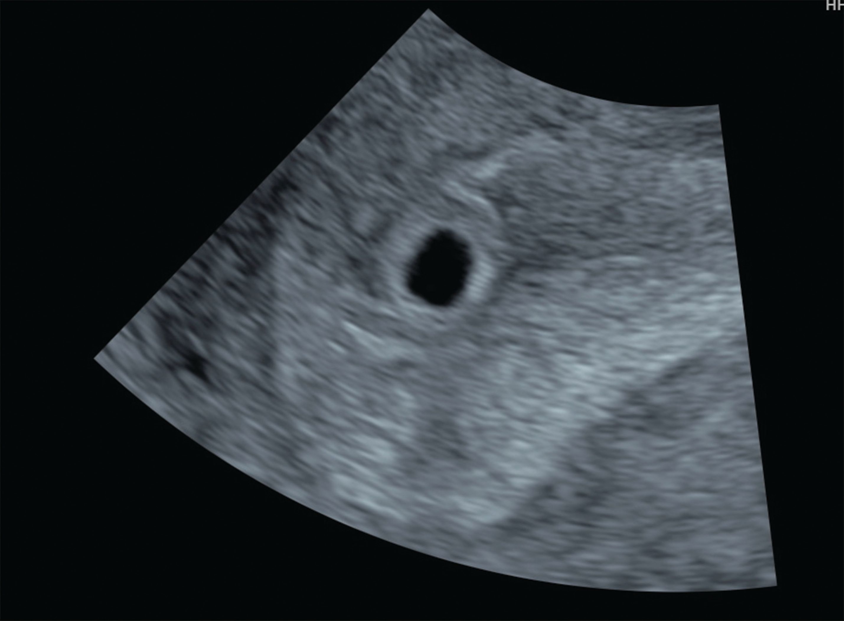 Ultrasound trimester normal first False